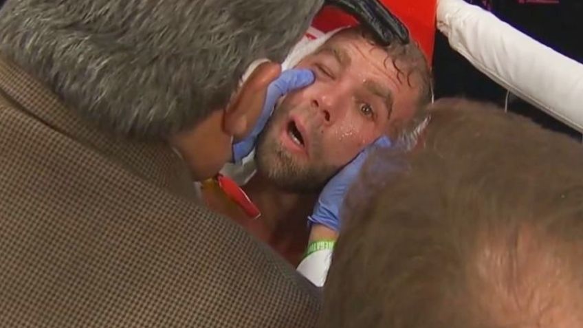 Billy Joe Saunders: Así se ve la fractura que le causó Canelo y que puede retirarlo