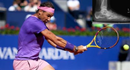 La enfermedad crónica de Rafael Nadal que podría retirarlo del tenis