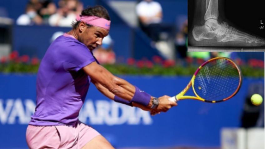 La enfermedad crónica de Rafael Nadal que podría retirarlo del tenis