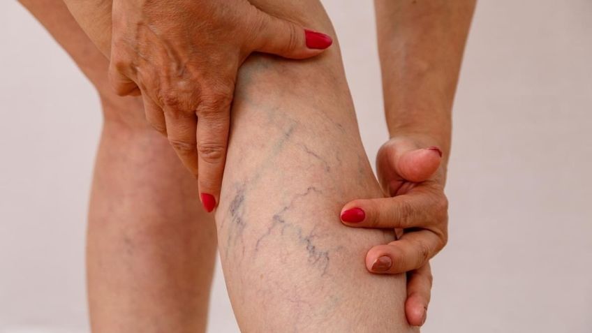 ¿Qué ejercicios son buenos contra las várices? 9 tips para su tratamiento