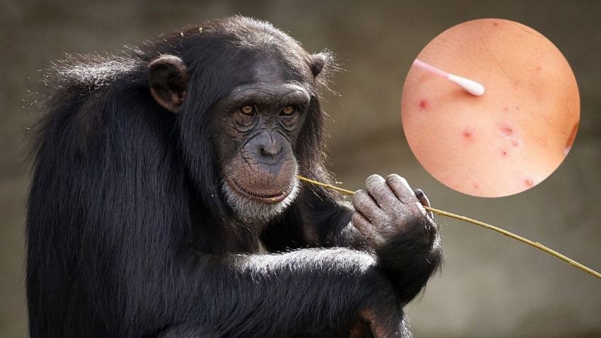 Viruela del Mono: ¿Cuáles son los síntomas y cómo se contagia?