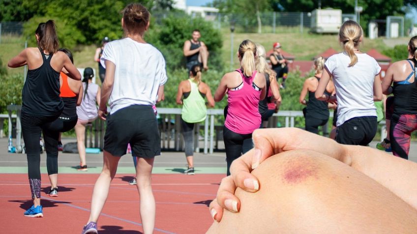 ¿Por qué me salen moretones en las piernas cuando hago ejercicio?