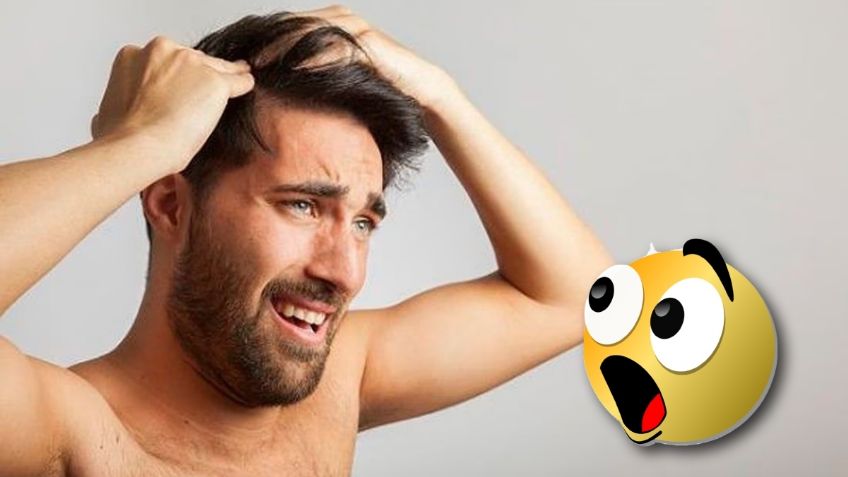 Cuánto cuesta un injerto de cabello en CDMX, por si te estás quedando calvo