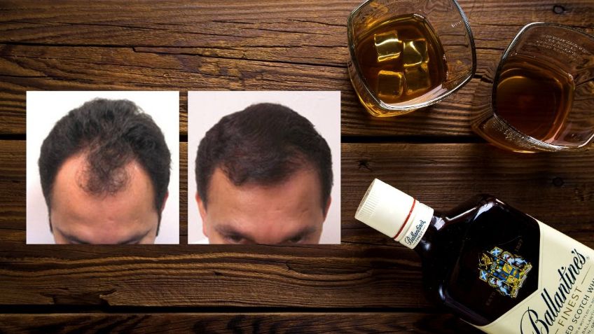 ¿Tienes problemas con la caída del cabello? No consumas estos 3 alimentos