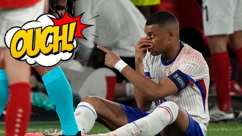Así luce la nariz rota de Mbappé luego de recibir un fuerte golpe en la Eurocopa 2024