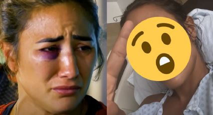 Exatlón México: Así quedó Paulette Gallardo tras operarse la nariz luego de su fractura | FOTO