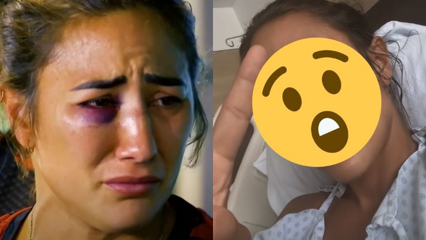 Exatlón México: Así quedó Paulette Gallardo tras operarse la nariz luego de su fractura | FOTO