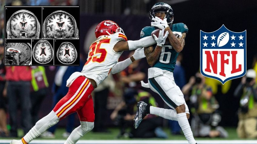 NFL: ¿Qué es la Encefalopatía Traumática Crónica, enfermedad que afecta a varios jugadores?